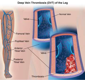 Deep Vein Thrombosis (DVT) Of the Leg