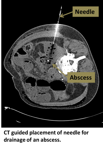 CT guided placement of needle for drainage of an abscess