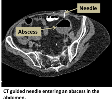 CT guided needle entering an abscess in the abdomen