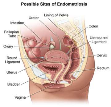 Endometriosis Illustration