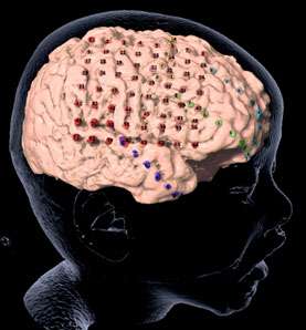 Image of brain mapping - Epilepsy
