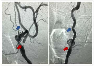 Close-up angio images showing carotid stenting procedure with labeled arteries.