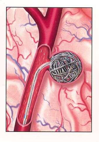Figure 7. Endovascular occlusion of aneurysms includes the use of detachable coils.