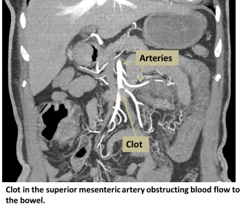 Clot in the superior mesenteric artery obstructing blood flow to bowel