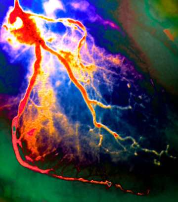 Image of heart occlusion