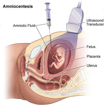 Illustration of Amniocentesis