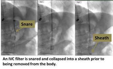 An IVC filter is snared and collapsed into a sheath prior to being removed from the body