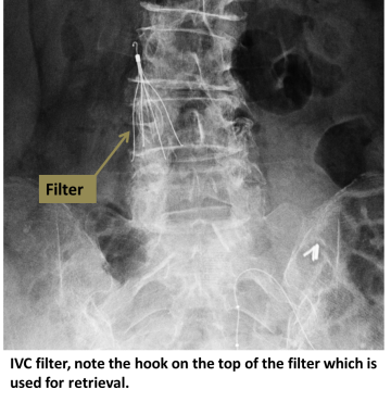 IVC filter (note the hook on top of the filter which is used for retrieval)