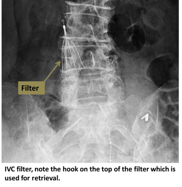 IVC filter (note the hook on top of the filter which is used for retrieval)