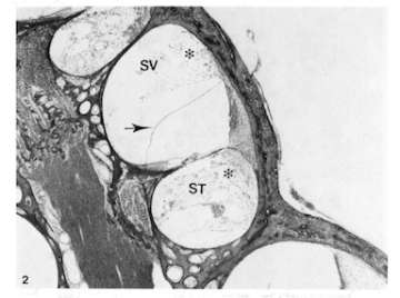 Middle turn of cochlea of the chinchilla 12 hours following endotoxin instillation