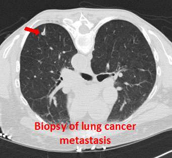 Biopsy of lung cancer metastasis