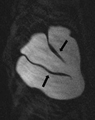 Figure 7: T2-weightedfat-saturated image demonstrates normal radial fold extending from the surface of the implant (blackarrows).