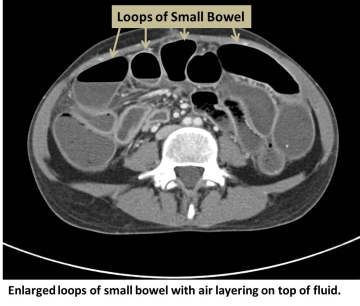 Enlarged loops of small bowel with air layering on top of fluid