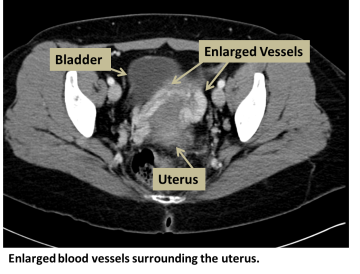 Enlarged blood vessels surrounding the uterus.