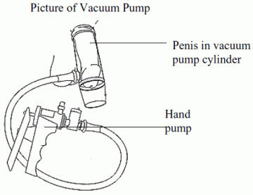 penis vacuum