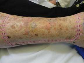 squamous on arm