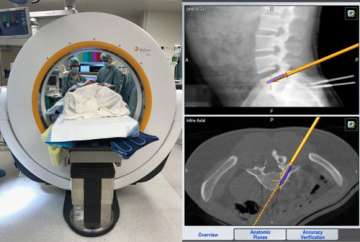 Depiction of Spine Surgery with GPS Precision