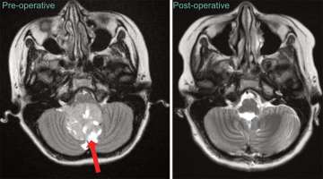 X-ray of brain tumor