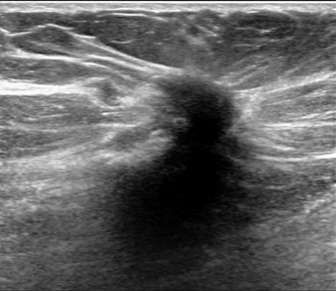 Hypoechoic mass with indistinct margins