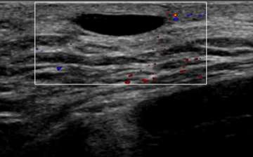 Well-circumscribed, anechoic, parallel, and avascular tubular structure with well-defined borders