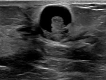 A well-circumscribed, anechoic, parallel, and avascular tubular structure with well-defined borders