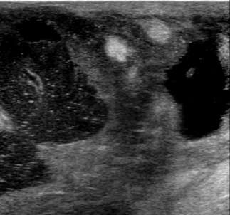 A breast abscess with marked thickening of the overlying skin