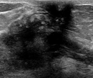 Ultrasound demonstrating nipple retraction with an underlying heterogeneous mass with irregular contours.