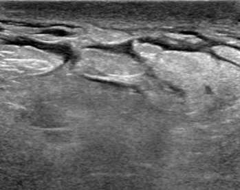 Example of skin and trabecular thickening, with increased fluid (hypoechoic) surrounding normal fat lobules within the breast