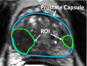 MRI showing regions of interest suspicious for prostate cancer