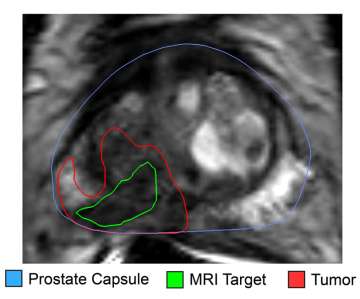 MRI underestimation of true tumor size.