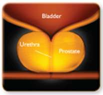 UroLift Procedure - An enlarged prostate compresses on the urethra, making it difficult for urine to flow.