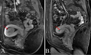 Cross-section image of a pre-treatment fibroid and post-treatment