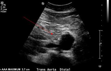 Ultrasound image of AAA detected by screening, measuring 3.7 cm (red arrow)