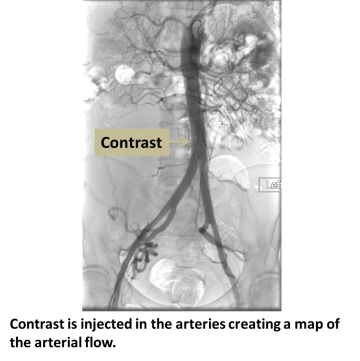 Contrast is injected in the arteries creating a map of the arterial flow