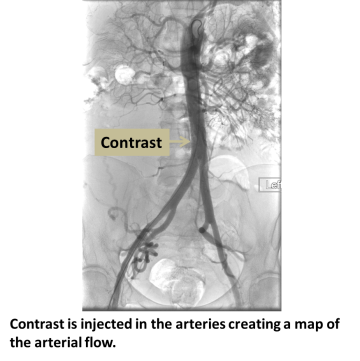 Contrast is injected in the arteries creating a map of the arterial flow