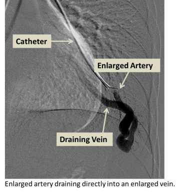 Enlarged artery draining directly into an enlarged vein
