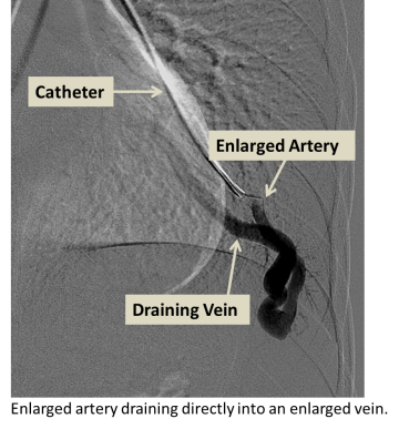 Enlarged artery draining directly into an enlarged vein