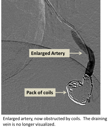 Enlarged artery obstructed by coils. The draining vein is no longer visualized.