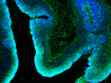 Microscopy image of a skin tumor