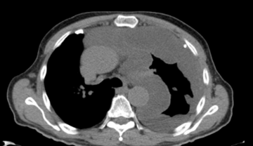 CT scan showing pleural effusion (fluid buildup) around the left lung, which can be a sign of mesothelioma.