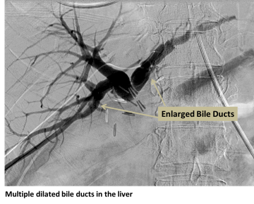 Biliary Obstruction in the liver