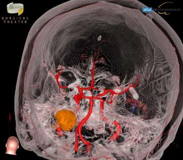 X-ray image of brain tumor in child