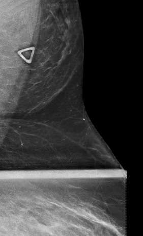 Case: Accessory  Breast Tissue Figure 1