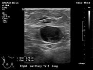 Case: Axillary Lymphadenopathy  Figure 4