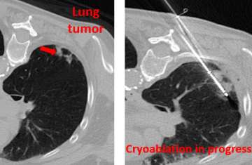 Lung tumor undergoing cryoablation