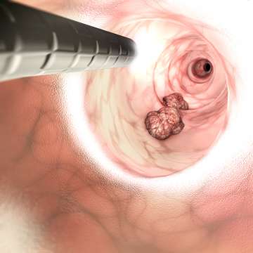 Illustration of colonoscopy.