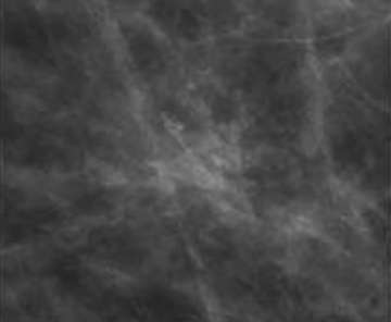 Calcifications Amorphous V2