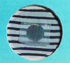 Figure showing a polypropylene patch covering the hernia
