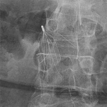 IVC Filter with fractured leg