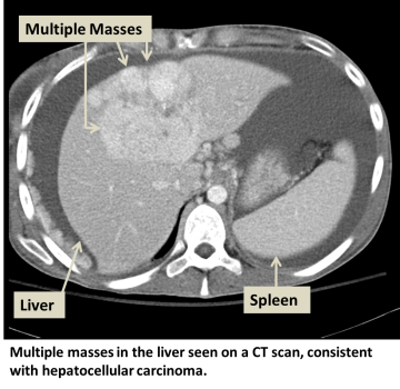 Multiple masses in the liver seen on a CT scan, consistent with hepatocellular carcinoma